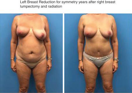 Fig. 21.1, Delayed contralateral reduction for asymmetry years after right lumpectomy and whole breast irradiation.