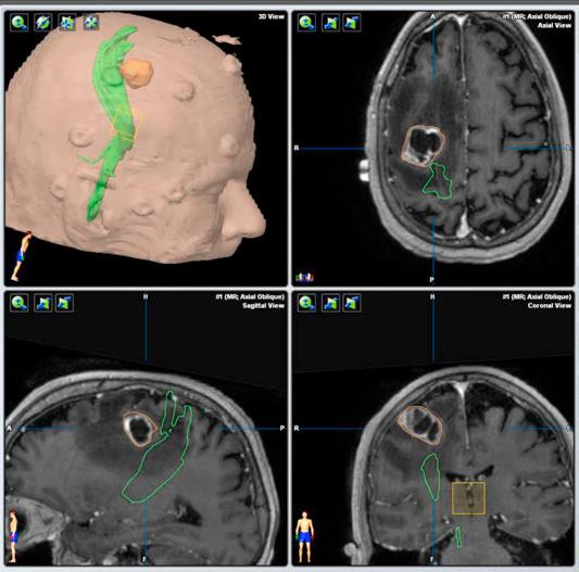 Figure 13.1, Display of the corticospinal fibers (green), derived from diffusion tensor imaging superimposed on a high resolution T1-volume MRI after gadolinium contrast administration, and their relationship to a right frontal metastatic tumor immediately anterior to the motor cortex.