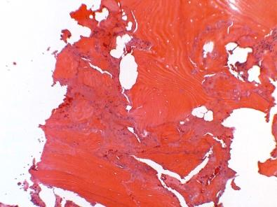 Figure 4-1, Needle biopsy from the spine of a 65-year old woman with a “sclerotic lesion” of bone. The biopsy is performed with a 14-guage needle, which is both narrow and lacking a serrated cutting edge. Consequently, the bone is fragmented and compacted with no marrow elements visible, and no geographic relationships preserved. This type of biopsy is suitable to confirm the diagnosis of metastatic tumors in bone when the primary site is already known and when the imaging demonstrates that the lesion is radiolucent.