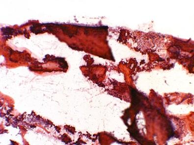 Figure 4-2, Histology of an open biopsy of a bone lesion with mixed sclerosis and radiolucency on radiographs. The tissue was received in multiple fragments that felt soft enough to the prosector to submit to histology without decalcification. Although the paraffin block could be cut, the sections were made with difficulty because the hard and soft parts of the tissue did not cut with uniform pressure nor produce sections of even thickness. In addition, there are tissue folds that cannot be corrected satisfactorily, and the bone details cannot be seen because the retained mineral overstains the trabeculae with hematoxylin. Note that the small cellular foci, which probably represent the pathology, are almost uninterpretable histologically. A short time in decalcification solution might have enabled the pathologist to interpret the tissue findings.