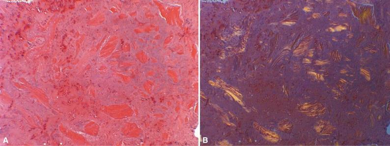 Figure 4-3, Tissue artifact produced by cutting a specimen section with an oscillating saw. The section demonstrates the histology of bone dust of varying particle size ( A ). The same section viewed in polarized light ( B ) demonstrates that most of the larger fragments are composed of lamellar bone but is not diagnostic. Higher magnification of the large fragments is deceptive. Although the osteocyte lacunae are devoid of osteocytes, this does not represent osteonecrosis but artifactual cell dropout due to the heat produced by friction.