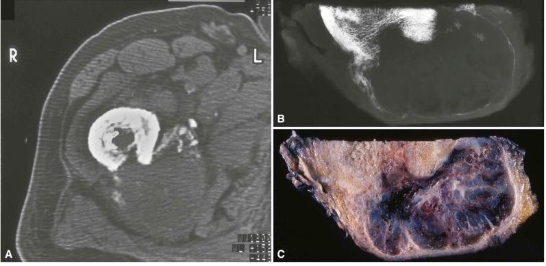 Figure 4-5, High-grade chondrosarcoma of the left femur. The computed tomography (CT) scan ( A ) demonstrates a radiolucent lesion both inside and outside the bone with a large posteromedial extraskeletal mass. The windowing is for soft tissue, but almost no density is seen in the soft tissue mass. A specimen radiograph of a transverse section through the specimen at the same level as the CT scan ( C ) is shown in ( B ). Notice a thin shell of calcified bone on the outside of the mass as well as three small areas of ossification not visible in the CT. The specimen radiograph is markedly similar to the CT but more sensitive.