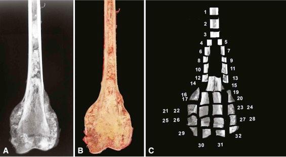 Figure 4-6, Whole-specimen radiograph ( A ) and corresponding specimen of osteosarcoma ( B ). The specimen is cut into block-sized pieces and mapped prior to decalcification of the blocks ( C ). Alternately, a specimen may be mapped whole and decalcified prior to sectioning if the decalcification is sufficiently gentle and monitored.