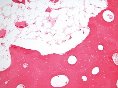 Figure 4-7, Overdecalcification of compact bone. There are very few nuclei left and there are also no nuclei visible in the marrow adipocytes. The marrow is probably not truly necrotic because there are visible erythrocytes in the marrow sinusoids and there is still some structure in the marrow. Acid decalcification preferentially inhibits hematoxylin staining. Similarly, if a properly decalcified block is inadequately washed, a stained section with visible nuclei may fade within several months.