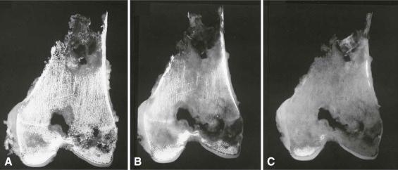 Figure 4-8, Slab specimen of a distal femur resected for metastatic carcinoma undergoing decalcification. A , The slab specimen contains multiple destructive lesions prior to decalcification. The specimen was placed in a solution of 20% formalin brought to 20% with formic acid in the presence of an ionic exchange resin. B , After 24 hours the specimen demonstrates decalcification of almost all cancellous bone and about half of the compact bone. C , After 48 hours, only the distal medial cancellous bone and a very small amount of cortex remain calcified.