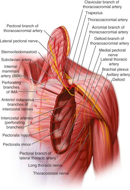 Figure 34.1, Pectoralis major flap.