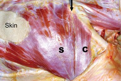 Figure 34.2, Postmortem specimen of the left pectoralis major myocutaneous flap showing the groove (arrow) between the clavicular (C) and sternocostal (S) heads. The skin island (Skin) is attached to the muscle.