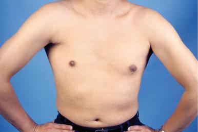 Figure 34.3, A patient with Poland's syndrome; he has congenital absence of his right pectoralis major muscle.