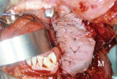 Figure 34.4, Thick skin paddle is not harvested with the muscle and a split-thickness skin graft is placed over the muscle (M) to be used for intraoral reconstruction. Muscle flap with split-thickness skin graft insetted in the oral cavity.