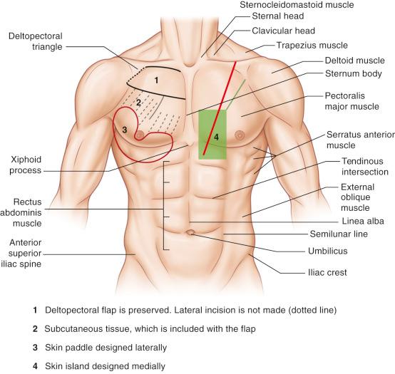 Figure 34.5, Markings of the incision for the skin island and chest wall to allow exposure of the pectoralis major muscle and preservation of the deltopectoral flap. Lateral design allows for wider arc of rotation. Subcutaneous tissue over the muscle must be included with the flap.