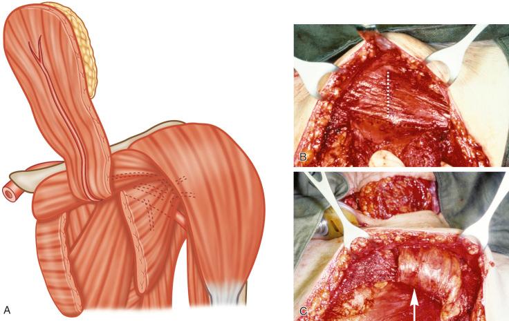 Figure 34.6, (A) Line drawing showing the bulge of the muscle over the left clavicle. (B) Clavicular head of the pectoralis major muscle is intact, planned incision is marked by dotted line. (C) Muscle bulge over the clavicle with the intact clavicular head (arrow).