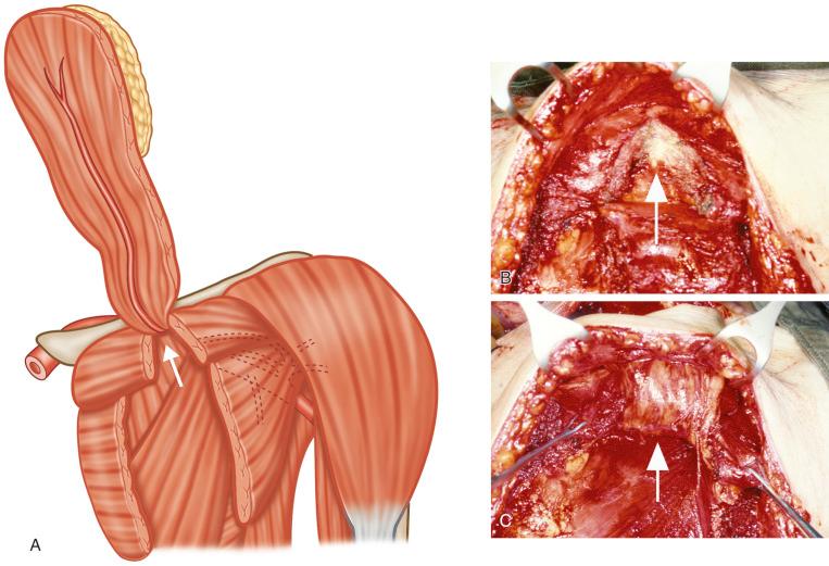 Figure 34.7, (A) Line drawing showing the pedicle of the pectoralis major muscle sitting in the gap created by dividing the clavicular head (arrow). (B) Clavicular head incised and muscle fibers retract to give a triangular space for the pedicle (arrow). (C) Pedicle of the myocutaneous flap (arrow) sits comfortably in the space that developed following incision of the clavicular head.