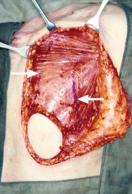 Figure 34.8, Incision marking on the muscle showing only the portion of muscle that carries skin island is included in the myocutaneous flap (arrows).