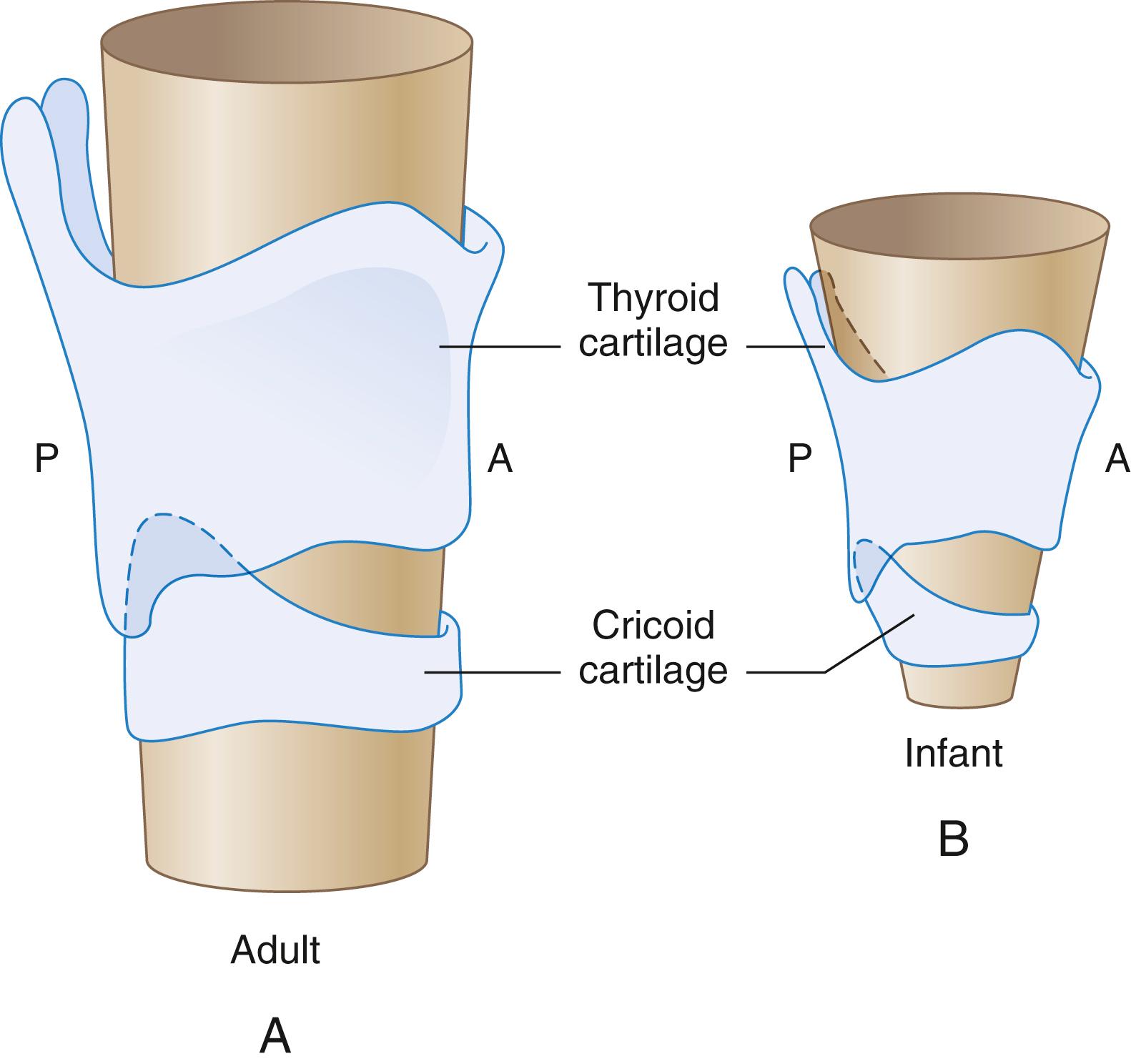 Fig. 77.3, The narrowest part of the adult larynx and the pediatric larynx is at the level of the cricoid cartilage. Traditionally, the adult larynx was thought to be cylindrically shaped, but autopsy data suggest that the narrowing in adults (A) is not as pronounced as it is in infants (B). The narrowest part of the infant larynx occurs at the level of the cricoid cartilage; the normal adult configuration of the larynx is not achieved until the teenage years. This anatomic difference is one of the reasons uncuffed tracheal tubes have been traditionally preferred for children younger than 6 years of age. A, Anterior; P, posterior.