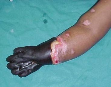 FIGURE 51.1, Peripheral gangrene of the hand. Severe dehydration in this infant was caused by severe gastroenteritis. Dehydration associated with delayed presentation, hypernatremia, herbal medications, and pneumonia are common contributors to this disastrous outcome.