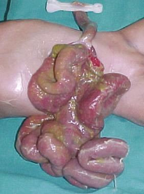 FIGURE 51.2, Gastroschisis is a major problem in the developing world. The outcome is poor because of a paucity of facilities for neonates. This defect was not diagnosed antenatally, and the patient presented late for closure, which proved difficult. Ventilatory support was not available, and a silo was fashioned. Unfortunately, the child died of overwhelming sepsis a week later.