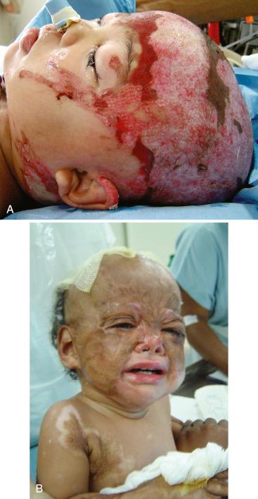 FIGURE 51.3, Facial burn injuries are common in the developing world, and these children may require multiple episodes of anesthesia. A , Flame burns of the face are invariably associated with inhalation injuries that may necessitate ventilatory support in intensive care facilities, which are not readily available. B , Pain management and pain assessment are challenging. The pained expression on this child's face is one of fear (and possible indignation about having the photograph taken) rather than actual pain.