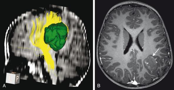 e-Figure 35.1, Presurgical tractography.