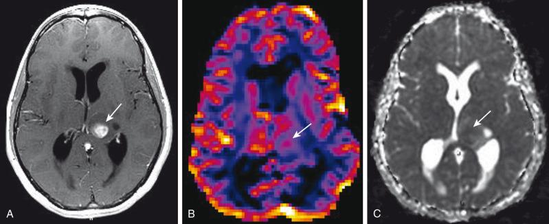 e-Figure 35.3, Perfusion-weighted imaging.