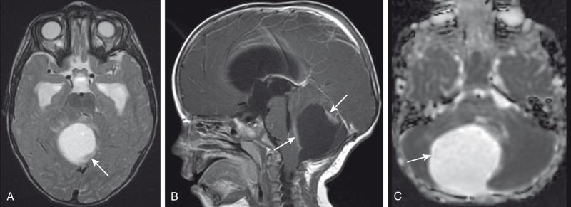 Figure 35.4, Cerebellar astrocytoma.