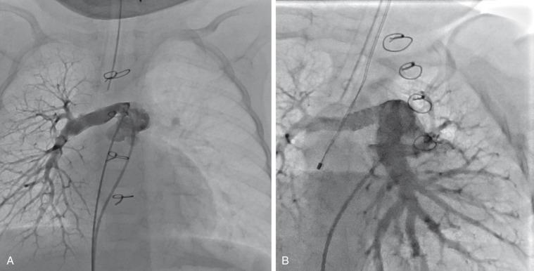 e-Figure 68.3, Pulmonary artery stenosis.