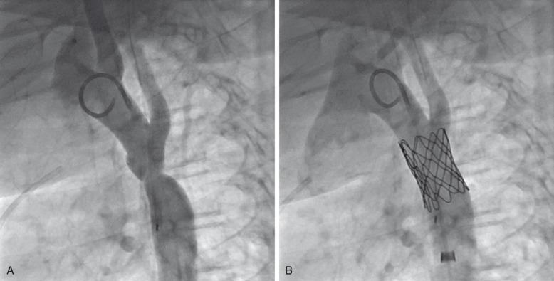 Figure 68.4, Aortic coarctation.