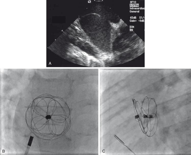 e-Figure 68.5, Atrial septal defect.