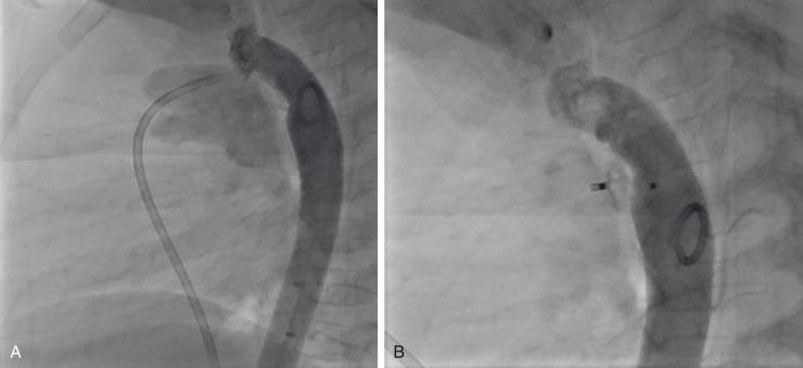 e-Figure 68.6, Patent ductus arteriosus.