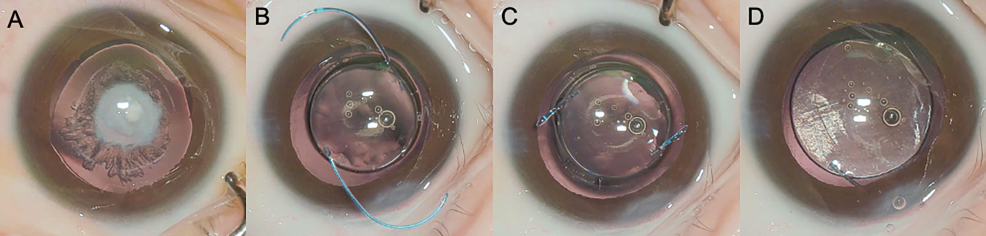 Fig. 40.1, (A) Surgical microscope view at the beginning of surgery in a patient with congenital cataract and microspherophakia. The reduced equatorial diameter is evident. (B) Immediately before IOL implantation, it is clear that this 3-piece IOL with 5.5 mm of optic diameter and 12.5 mm of haptic-to-haptic diameter will not fit with its original configuration in this small capsular bag. (C) Both haptics of the 3-piece IOL are partially amputated. (D) At the end of the procedure, the IOL is in the bag and stable, with both partially amputated haptics anchoring it to the bag, avoiding its anterior or posterior dislocation, in spite of the anterior and posterior capsulorrhexis.