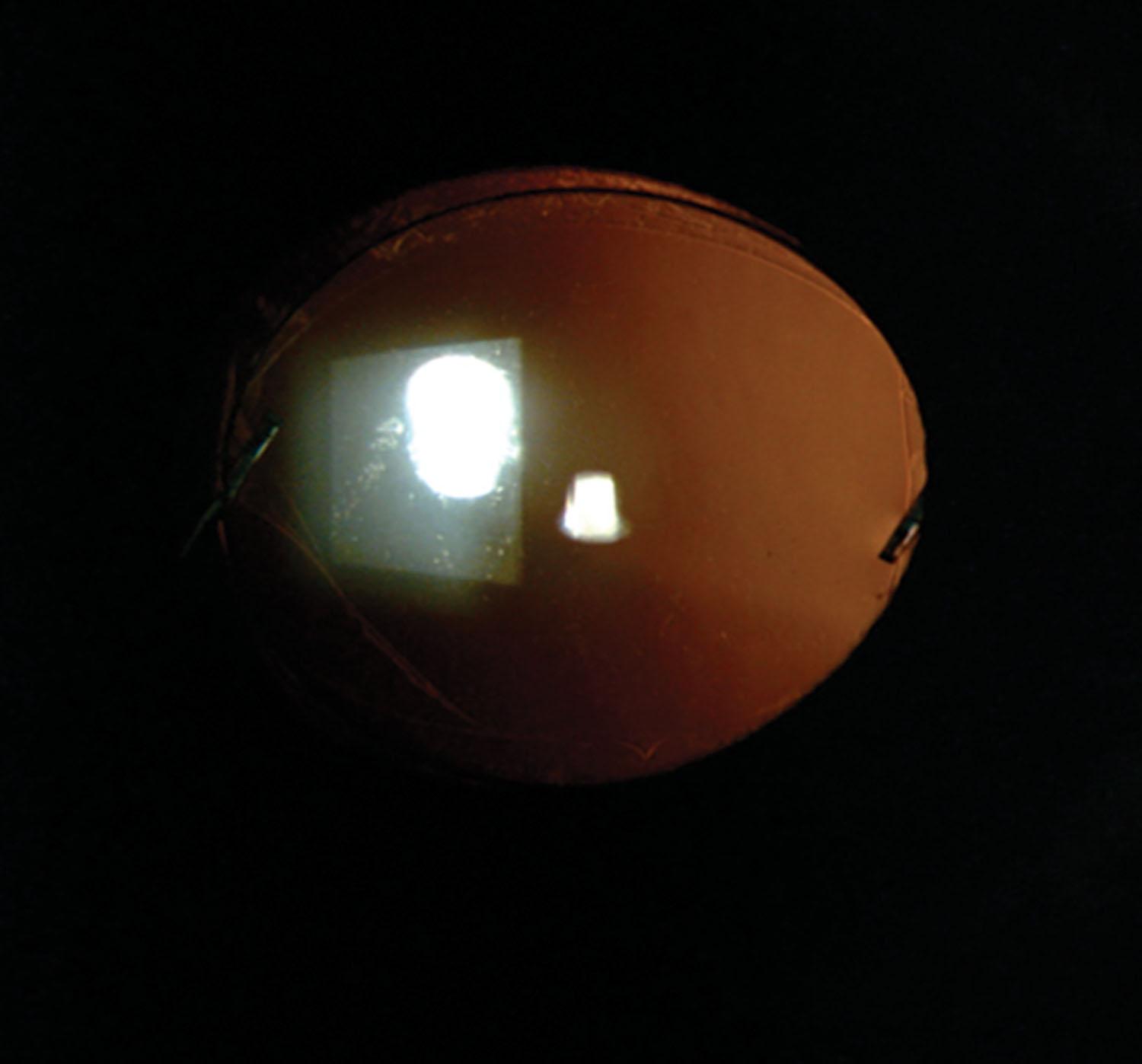 Fig. 40.3, Slit lamp photograph evidencing a 3-piece IOL with posterior optic capture. This IOL was implanted in the sulcus with its optic posteriorly captured because the child had a spontaneous large posterior capsular defect.