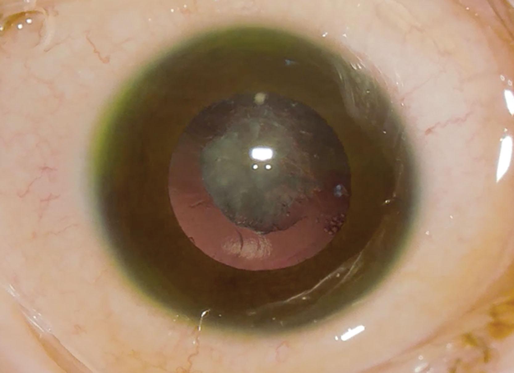 Fig. 40.2, Surgical microscope view of an eye with posterior lenticonus with the lens opacification delimitating the posterior capsular opening.