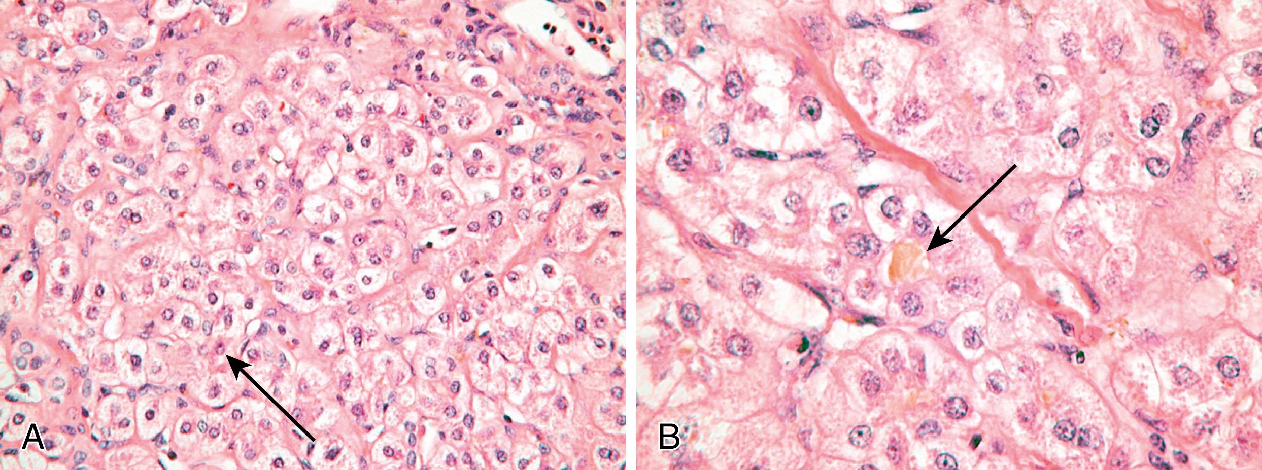 Fig. 70.2, Liver histopathology in progressive familial intrahepatic cholestasis type 1 (PFIC-1) (FIC1) disease with (A) hepatocyte swelling due to hepatocellular and canalicular cholestasis and (B) bile canaliculi distended with thick bile (arrow) .