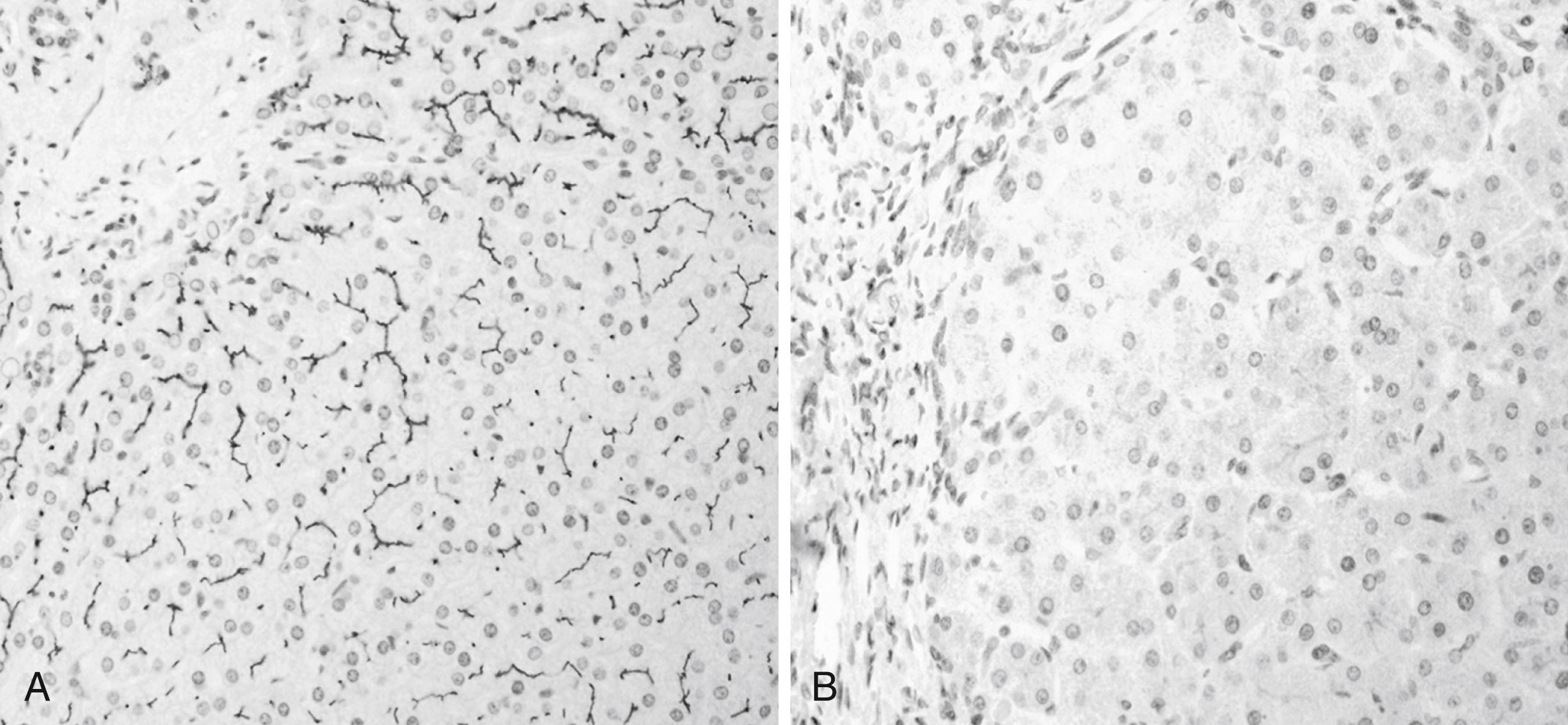Fig. 70.4, Hepatic immunohistochemical staining for bile salt export pump (BSEP) expression reveals (A) normal expression in a control liver versus (B) no staining in the liver of a progressive familial intrahepatic cholestasis type 2 (BSEP deficiency) patient.