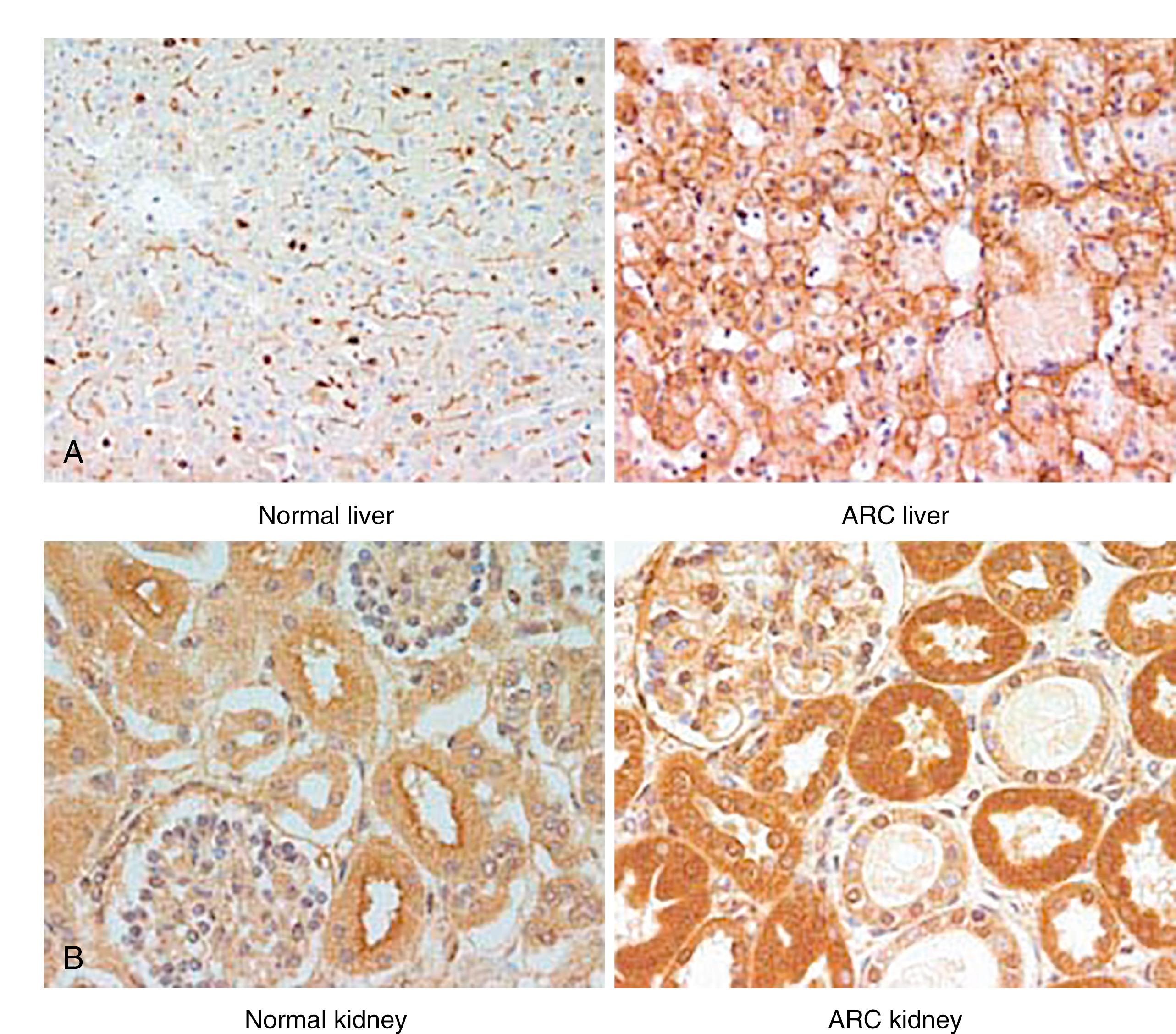 Fig. 70.5, Immunostaining of liver and kidney biopsy samples from individuals with arthrogryposis multiplex congenita, renal dysfunction, and cholestasis syndrome (ARC) . (A) Immunostaining with polyclonal antibody to carcinoembryonic antigen (CEA) (original magnification, ×200). Formalin-fixed, paraffin-embedded liver from an individual with ARC from family ARC09. Distribution of CEA, represented as the darkest stained areas in each panel, is markedly disturbed in the image on the right. In the age-matched control (left) , marking for CEA is limited to the canalicular membrane. In the individual with ARC, CEA is seen in cytoplasm and at basolateral membranes as well. (B) Immunostaining with antibody to CD26 (original magnification, ×400). Formalin-fixed, paraffin-embedded kidney from an individual with ARC from family ARC01 and an age-matched control. Loss of brush-border accentuation is apparent in the individual with ARC in the image on the right.