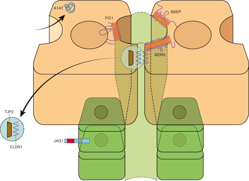 Fig. 63-1, The site of molecular defects that result in intrahepatic cholestasis in children, with accumulation of mutant α 1 -antitrypsin (A1AT) in the cytoplasm, localization of the canalicular proteins familial intrahepatic cholestasis 1 (FIC1), bile salt export pump (BSEP), and multidrug resistance protein 3 (MDR3), the relationship between tight junction protein 2 (TJP2) and the claudin 1 (CLDN1), and the cholangiocyte expression of JAG1 .