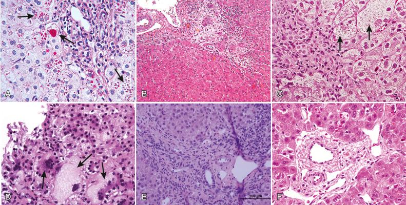 Fig. 63-2, A, Periodic acid–Schiff and diastase staining of a liver section showing cytoplasmic accumulation of mutant α 1 -antitrypsin (ZZ phenotype; arrows ) and hematoxylin and eosin staining of liver biopsies from children with: ( B ) cystic fibrosis (pericholangitis and accumulation of eosinophilic material in bile ducts—large and small globules), ( C ) bile acid synthetic defect (giant cell transformation; arrows ), ( D ) deficiency of bile salt export pump (lobular disarray and giant cell transformation; arrows ), ( E ) deficiency of multidrug resistance protein 3 (bile duct proliferation and portal inflammation), and ( F ) Alagille syndrome (absence of bile duct in a portal tract).