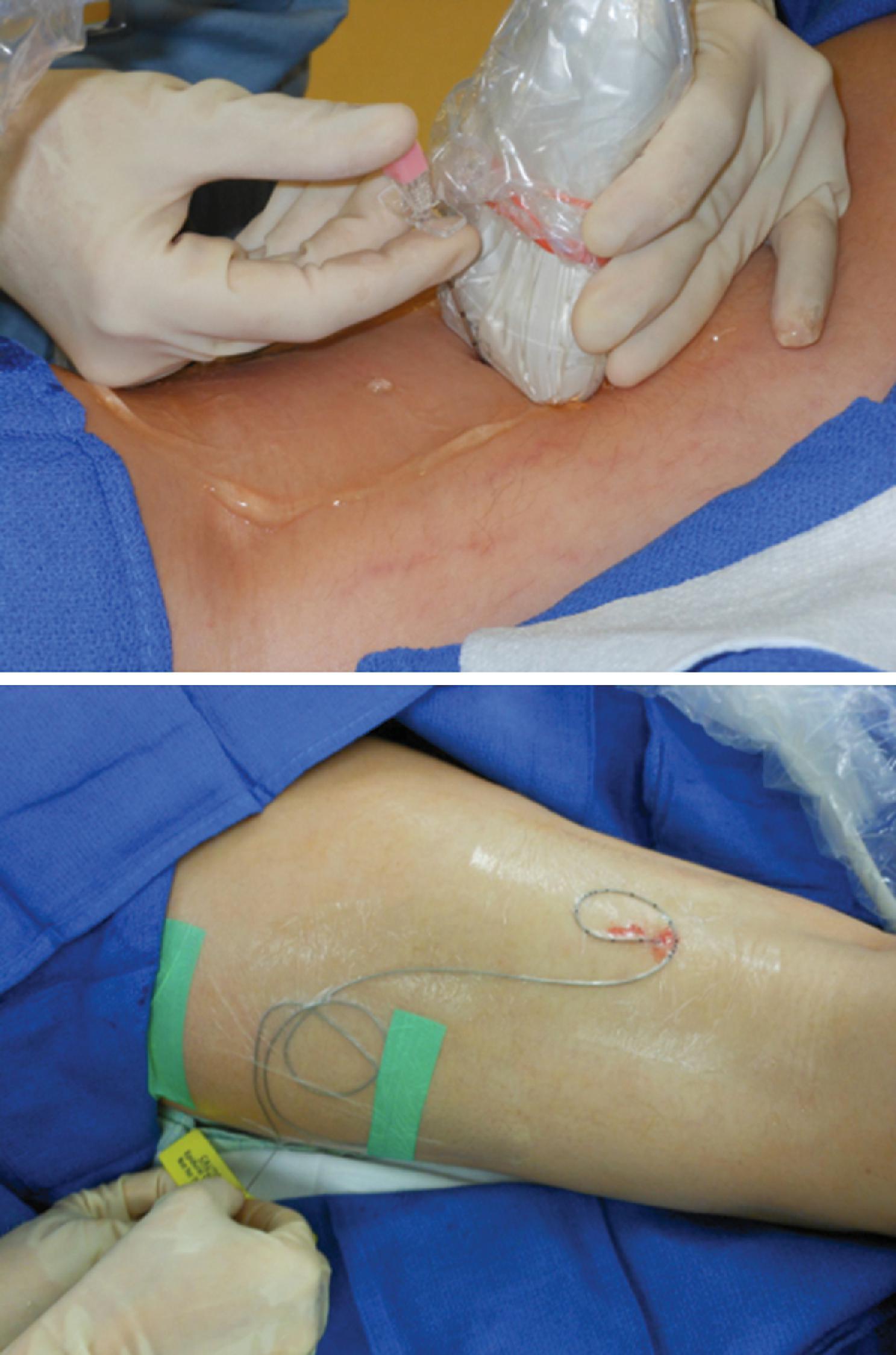 Figure 43.1, Sciatic nerve catheter for the management of complex regional pain syndrome type 1.