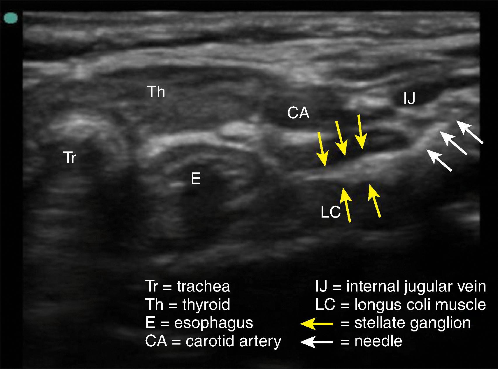 Figure 43.2, Image of ultrasound guided stellate ganglion blockade.