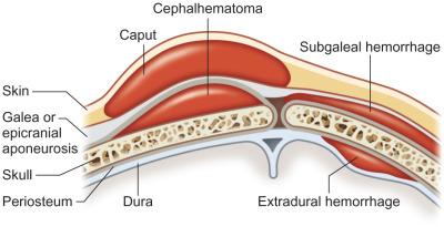 Fig. 3.2.1, Cephalhematomas are seen frequently with birth trauma and do not cross suture lines. The majority of subgaleal hematomas (90%) result from vacuum-assisted delivery and rupture of the emissary veins. Subgaleal hematomas can also be seen, however, in head trauma with associated skull fracture or intracranial hemorrhage and does cross suture lines. The growth of the hematoma can be insidious and lead to hemorrhagic shock.