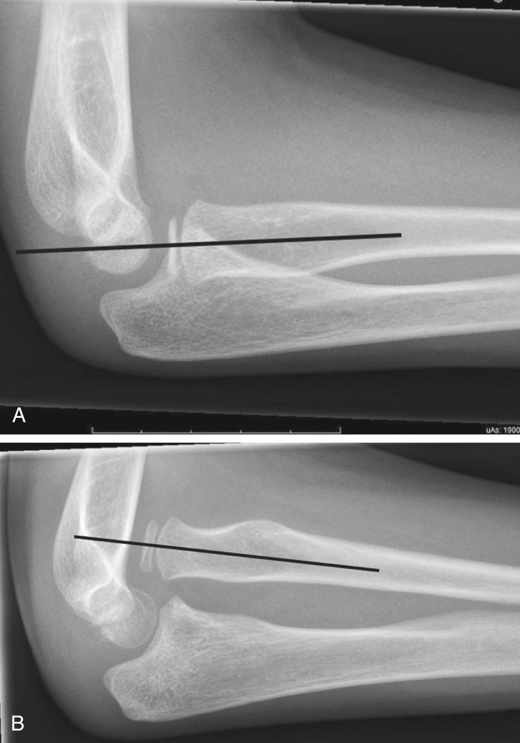 FIG 32.1, A line drawn through the center of the radial head and neck should intersect with the capitellum (A) but is anterior to the capitellum in an anterior radial head dislocation (B)