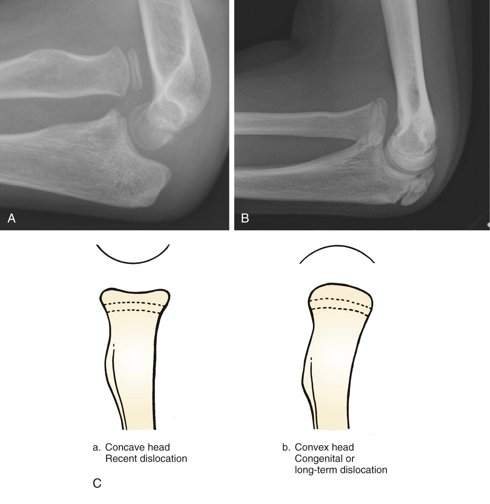 FIG 32.4, (A) Recent radiocapitellar dislocation with concave radial head. (B) Developmental radiocapitellar dislocation with convex radial head. (C) Schematic diagram of this finding.