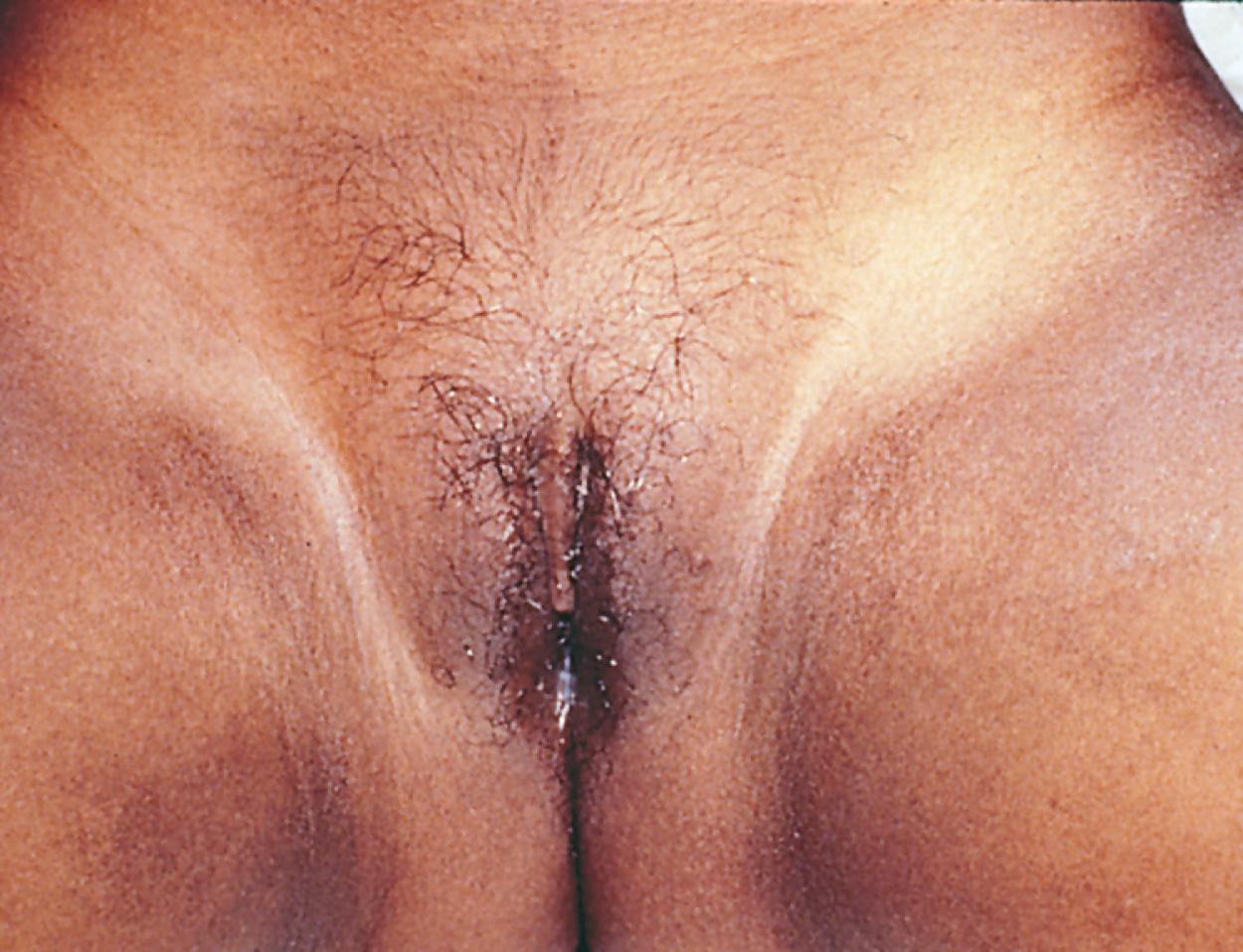 Fig. 9.11, Premature adrenarche. Pubic hair development in a prepubertal girl with premature adrenarche.