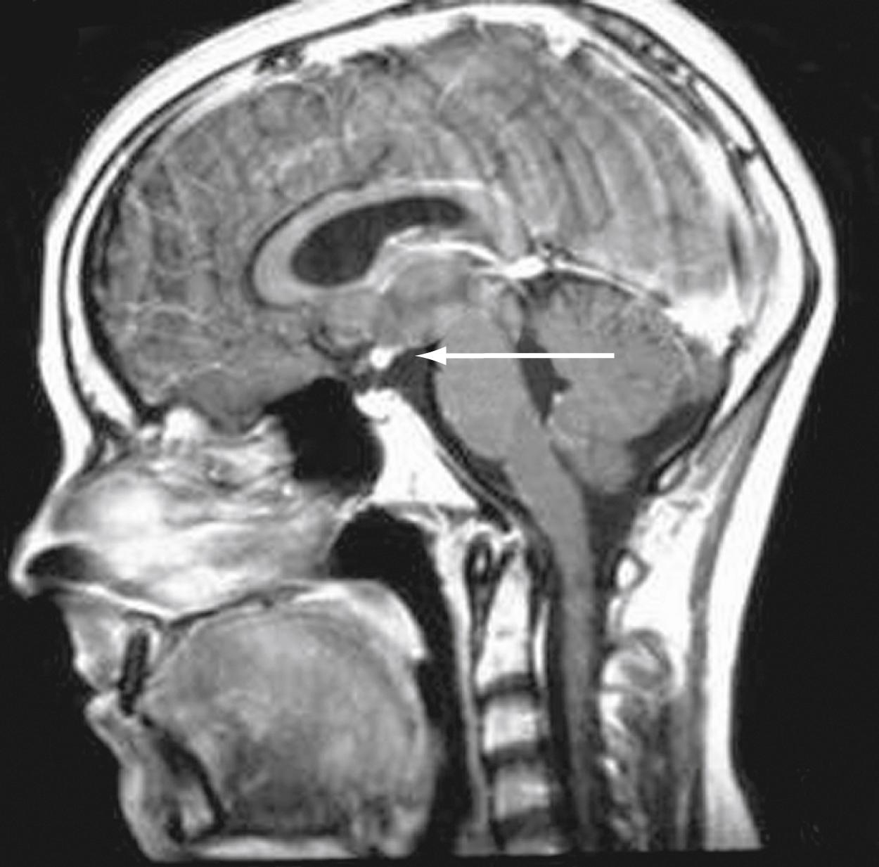 Fig. 9.14, Ectopic pituitary. Note the absent normal posterior pituitary bright spot (arrow) within the sella on magnetic resonance imaging (MRI). Instead, the bright spot is located in the median eminence.