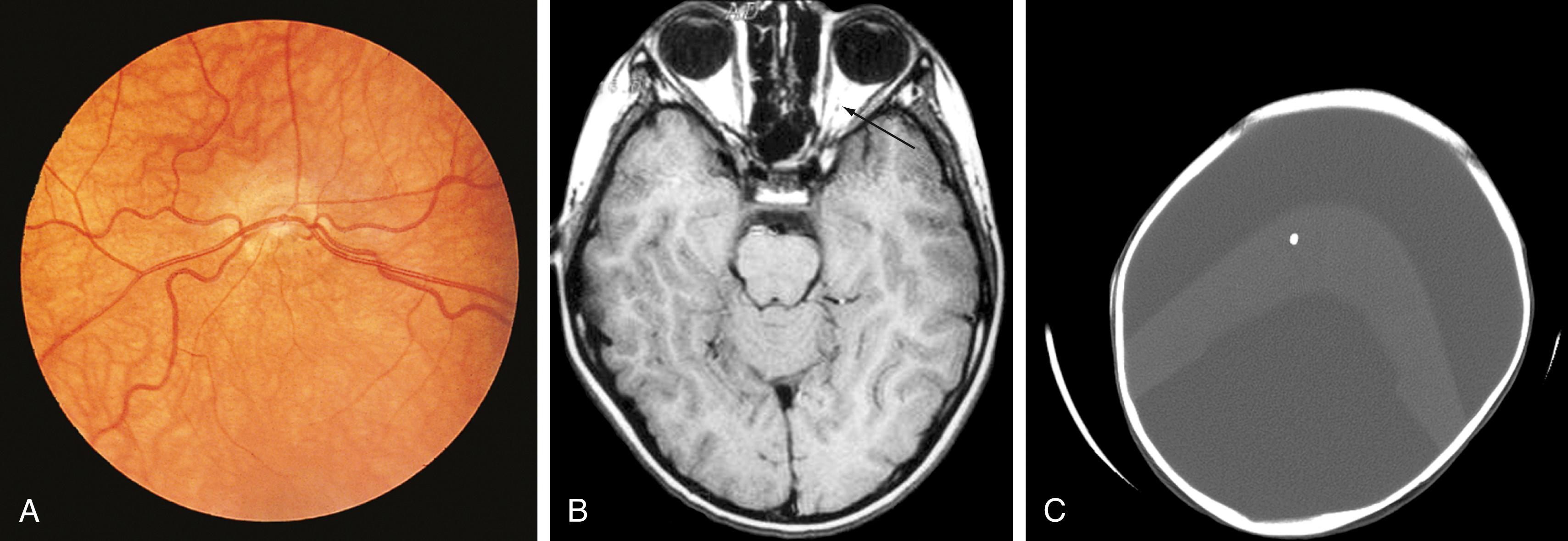 Fig. 9.15, Congenital abnormalities of the central nervous system (CNS) commonly associated with hypothalamic–pituitary dysfunction. (A) Pale optic discs noted on funduscopic examination indicative of optic nerve hypoplasia, which can be associated with septo-optic dysplasia. (B) Magnetic resonance image (MRI) showing optic nerve hypoplasia. (C) Holoprosencephaly.