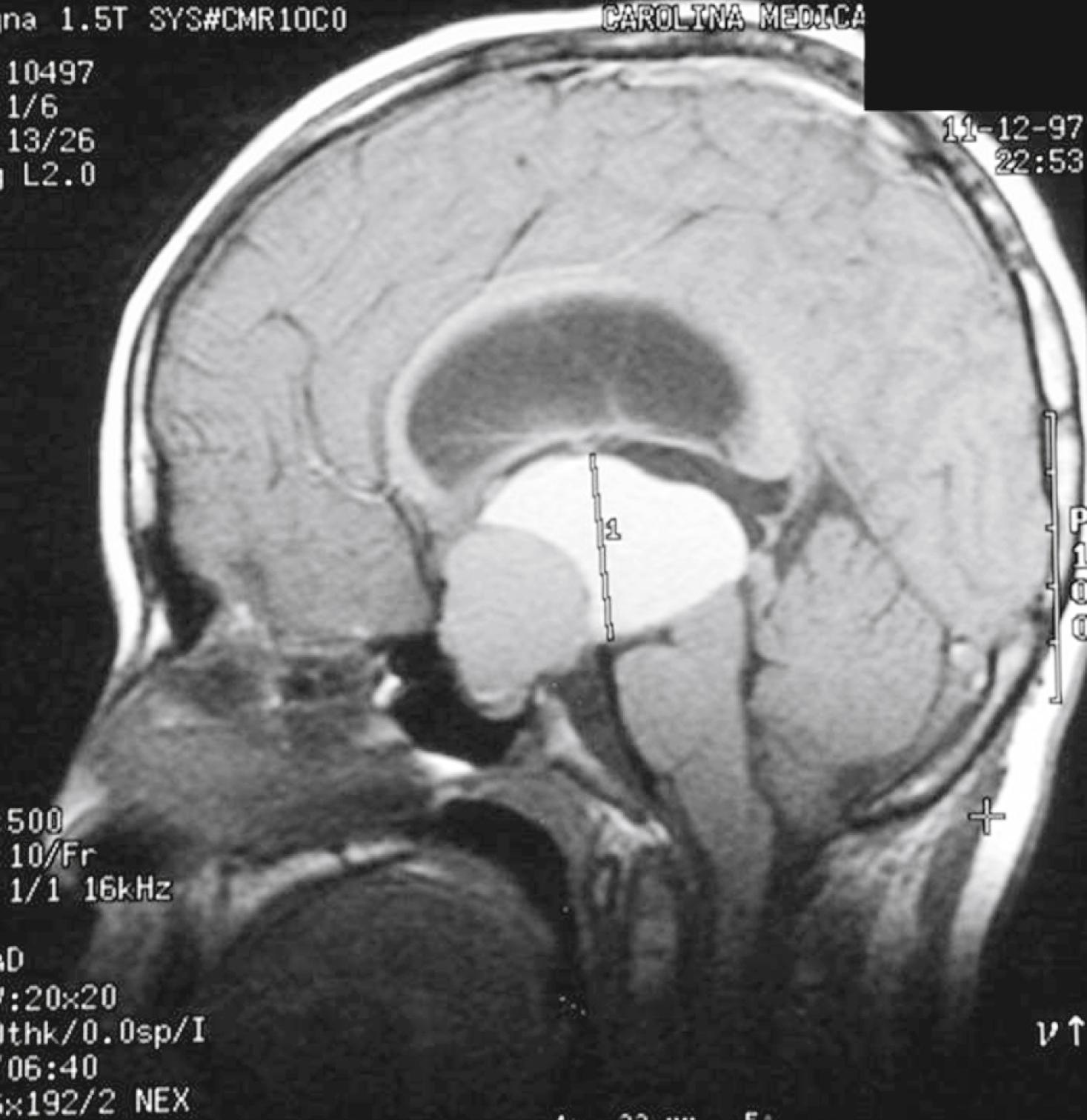 Fig. 9.16, Craniopharyngioma. Heterogeneous, densely enhancing suprasellar mass extending from the pituitary fossa into the hypothalamus and third ventricle.