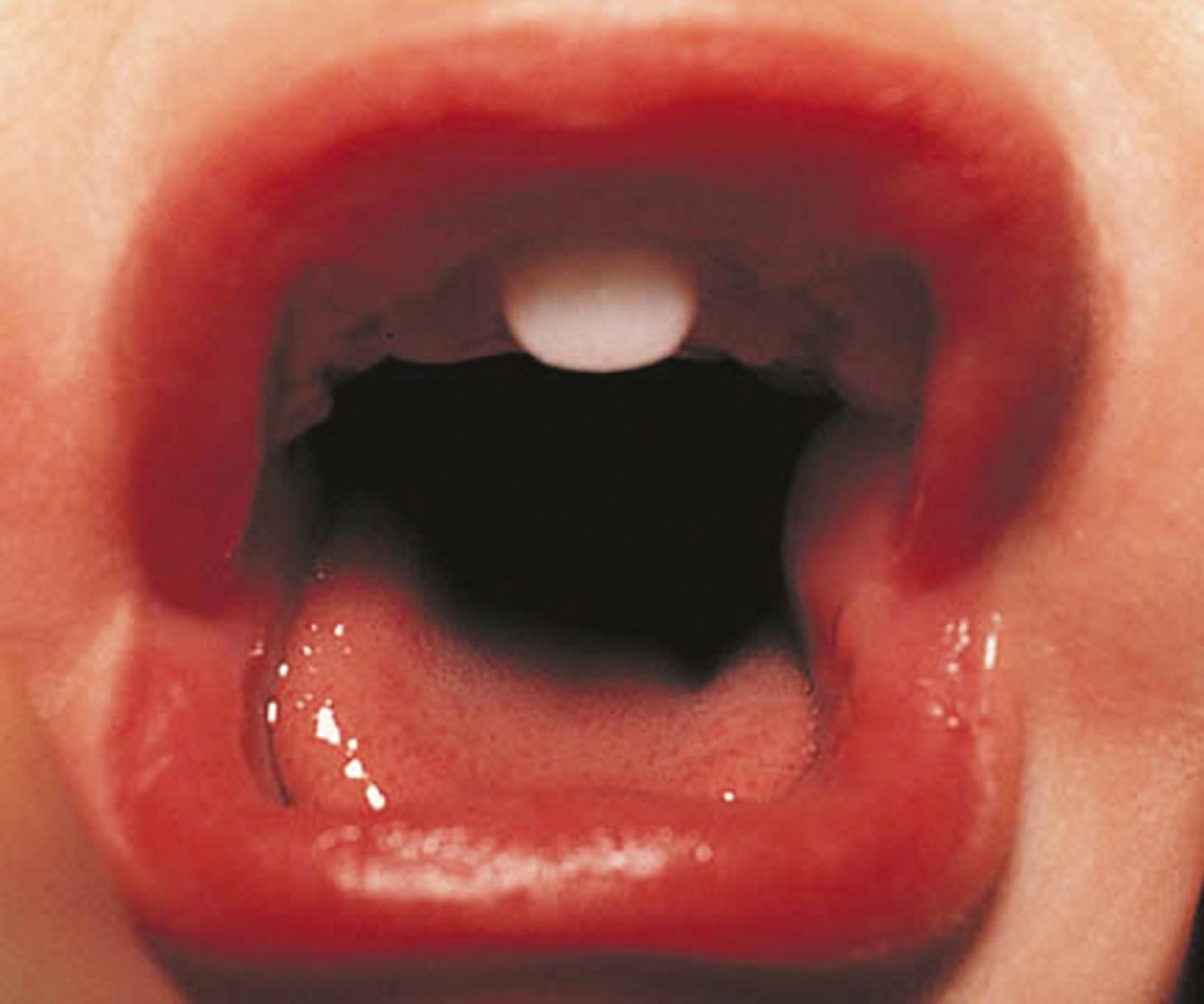 Fig. 9.17, Central maxillary incisor. The presence of a single central maxillary incisor should alert the clinician to investigate the possibility of growth hormone (GH) deficiency.