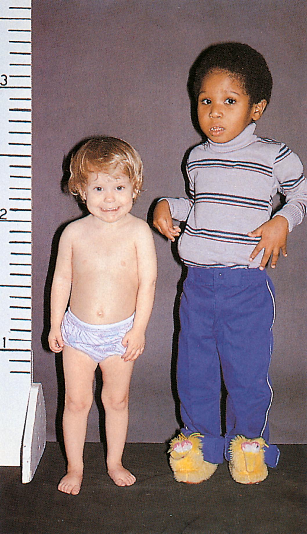 Fig. 9.19, Growth hormone (GH) deficiency. The normal boy (right) is in the 50th percentile for height. The short 3-year-old girl (left) has GH deficiency.