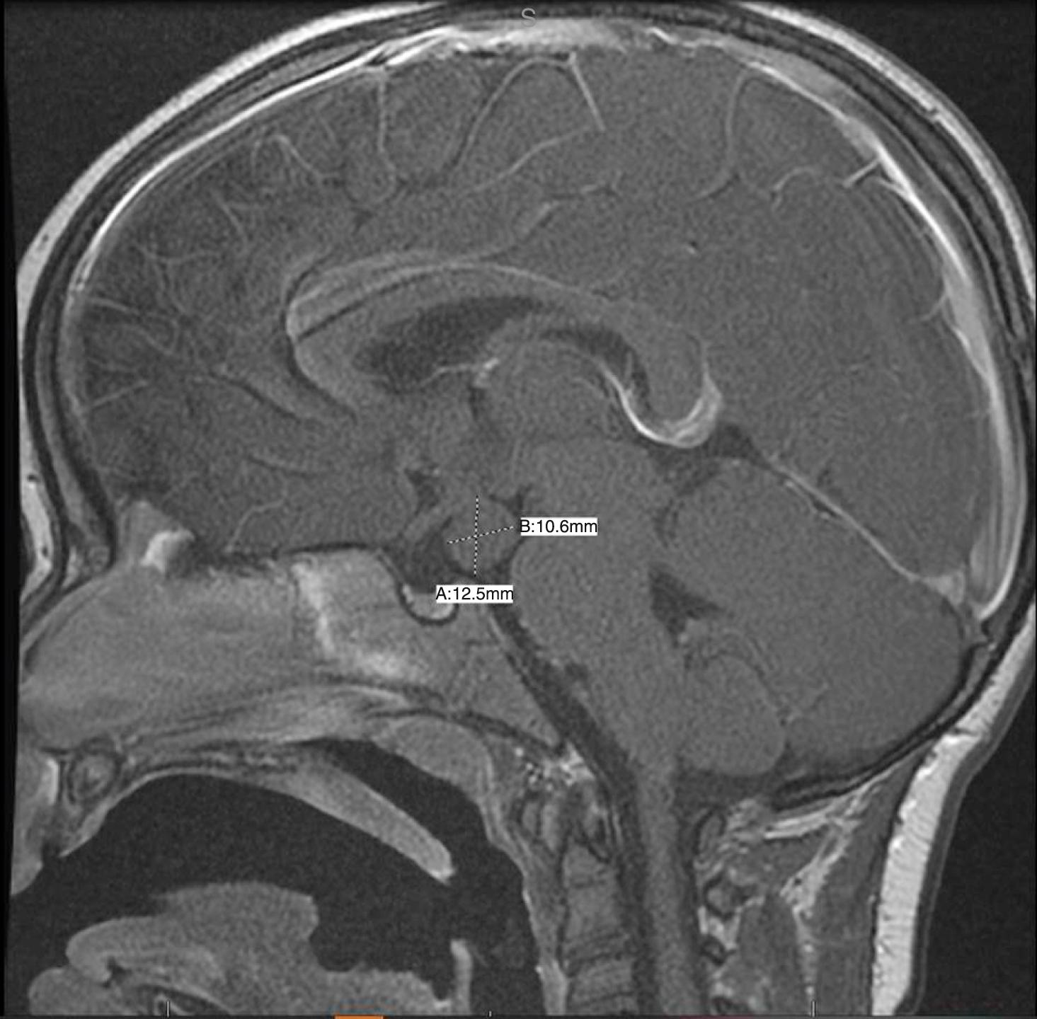 Fig. 9.9, Hypothalamic hamartoma in a 17-month-old girl with central precocious puberty.
