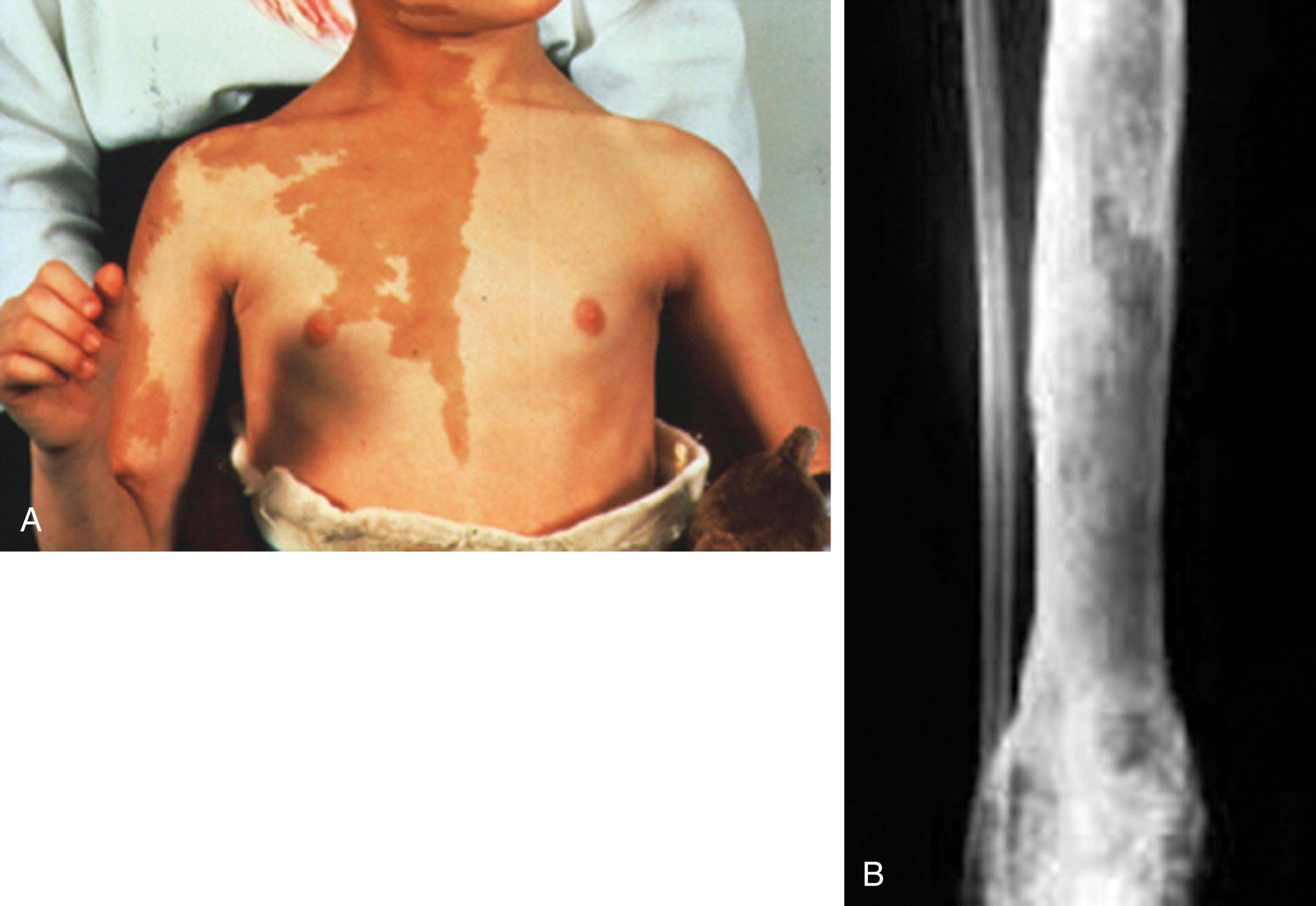 Fig. 9.10, McCune-Albright syndrome. (A) Irregular café-au-lait pigmentation over right anterior chest, shoulder, and right arm. (B) Polyostotic fibrous dysplasia. Multiple areas of fibrous dysplasia, most commonly found in long bones and pelvis.