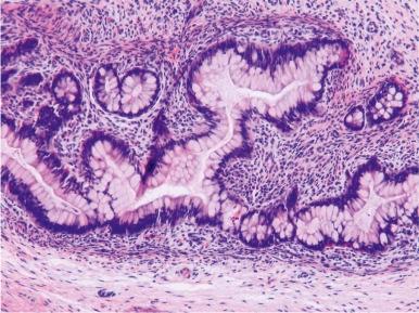 Figure 63-3, Mature teratoma with glandular differentiation.